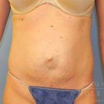 Abdominoplasty (tummy tuck) Case 16 Before