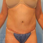 Abdominoplasty (tummy tuck) Case 17 After