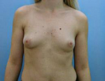 Breast Augmentation Case 1 Before