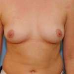Breast Augmentation Case 5 Before