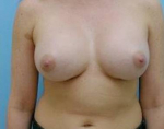Breast Augmentation Case 5 After