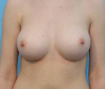 Breast Augmentation Case 6 After