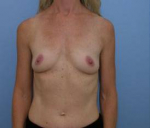 Breast Augmentation Case 7 Before