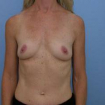Breast Augmentation Case 7 Before