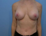 Breast Augmentation Case 7 After