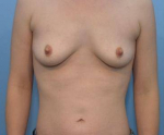 Breast Augmentation Case 8 Before