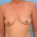 Breast Augmentation Case 9 Before