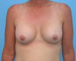 Breast Augmentation Case 9 After