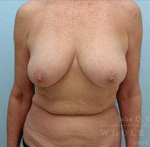Breast Lift Case 2 Before