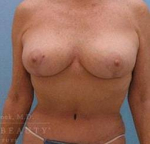 Breast Lift Case 2 After