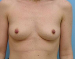 Breast Augmentation Case 13 Before