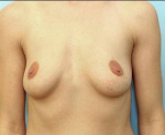 Breast Augmentation Case 10 Before