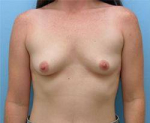 Breast Augmentation Case 14 Before