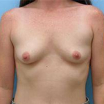 Breast Augmentation Case 14 Before