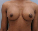 Breast Augmentation Case 16 After