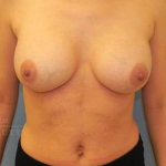 Breast Augmentation Case 18 After