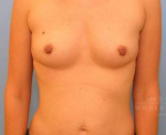 Breast Augmentation Case 19 Before