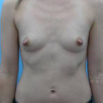 Breast Augmentation Case 20 Before