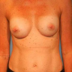 Breast Augmentation Case 21 After
