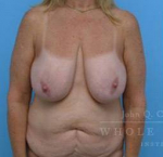 Breast Lift Case 5 Before