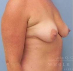 Breast Lift Case 8 Before