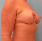 Breast Lift Case 8 After