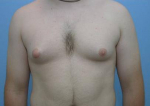 Breast Reduction for Men Case 1 Before