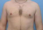 Breast Reduction for Men Case 1 After
