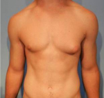 Breast Reduction for Men Case 2 Before