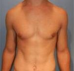 Breast Reduction for Men Case 2 After