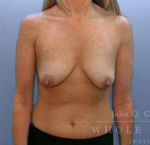 Breast Augmentation with Lift Case 2 Before