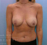 Breast Augmentation with Lift Case 2 After