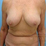 Structural Breast Surgery Case 2 Before