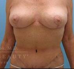 Structural Breast Surgery Case 2 After
