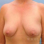 Breast Augmentation with Lift Case 10 Before