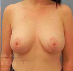 Breast Augmentation with Lift Case 10 After