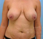 Structural Breast Surgery Case 3 Before