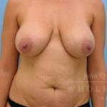 Structural Breast Surgery Case 3 Before