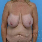 Structural Breast Surgery Case 5 Before