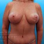 Structural Breast Surgery Case 5 After