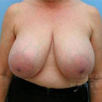 Breast Reduction Case 1 Before