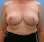 Breast Reduction Case 1 After