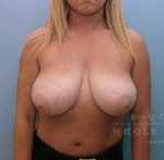 Breast Reduction Case 2 Before