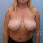Breast Reduction Case 2 Before