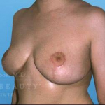 Breast Reduction Case 3 After
