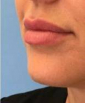 Lip Injections Case 1 After