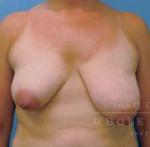 Breast Reduction Case 4 Before