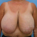 Breast Reduction Case 5 Before