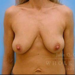 Structural Breast Surgery Case 8 Before