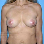 Structural Breast Surgery Case 8 After